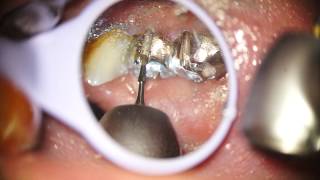 Indepartare ablatie lucrare dentara fara durere Dental crown removal Painless [upl. by Markland]