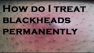 How do I treat blackheads permanently [upl. by Quintin]