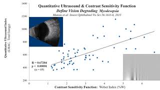 Vitrectomy Improves Visual Function in Multifocal Pseudophakia with Vision Degrading Myodesopsia [upl. by Nosreve]