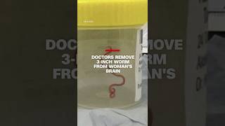 Worm removed from womans brain [upl. by La Verne]