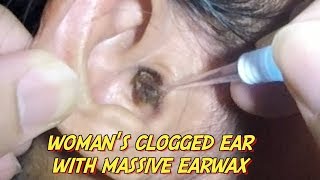 Womans Clogged Ear with Massive Earwax is Finally Removed [upl. by Sunev987]