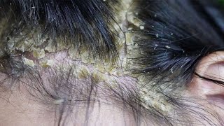 Dandruff scratching removal on head using black combing394 [upl. by Audwen]