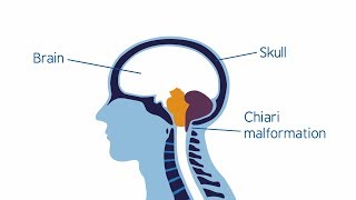 Understanding Chiari malformation [upl. by Sokim]