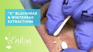 Blackheads Whiteheads Extractions on quotKquot  Part 2 [upl. by Haneeja]