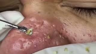 The Best Way to Remove Blackheads on Nose [upl. by Seyer]