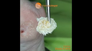 Thorough extraction of a foot corn  Podological treatment extract [upl. by Herring24]