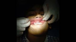 Eneucleation of periapical cyst [upl. by Imij]