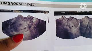 TVS ultrasound report reading [upl. by Eniawed]