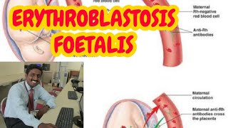 ERYTHROBLASTOSIS FOETALIS  TAMIL EXPLANATION [upl. by Pall]