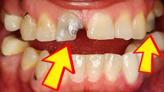 Dentist Explains Every Cause of Gray Teeth amp Why Your Tooth is Turning Grey Dark amp Possibly Dying [upl. by Olli]