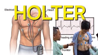 Apakah itu ujian Holter  holter health doctor cardiology [upl. by Ahsikyw]