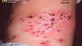 Squirming Larvae under my skin Graphic  African Insect Infection [upl. by True]