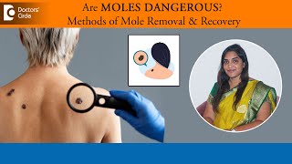 Are skin moles dangerous Know about the 5 methods for Mole RemovalDr Vandhana MDoctors Circle [upl. by Rist258]