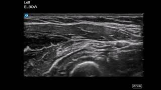 Elbow Ultrasound Radial Nerve Hydrodissection [upl. by Enwahs]