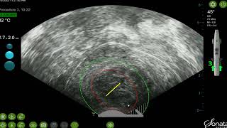 Sonata Thermoablation [upl. by Nahtnamas788]