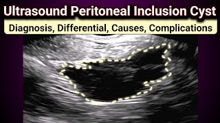 Ultrasound Peritoneal Inclusion Cyst  Post Surgical Complications [upl. by Ahsem]