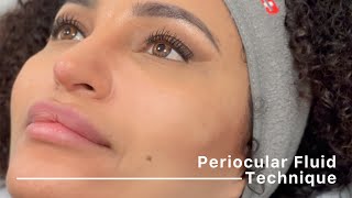 Periocular Fluid Technique complete protocol by Dr Siquier amp Dr Taskesen [upl. by Derzon]