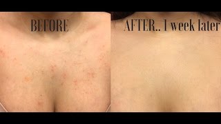 WATER CURED MY BODY ACNE  Holy Grail Product [upl. by Bow]