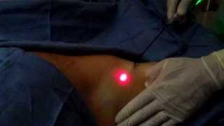 Laser Sweat Gland Ablation in Pearland TX [upl. by Kunin]