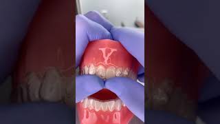 Invisalign tips [upl. by Ben]