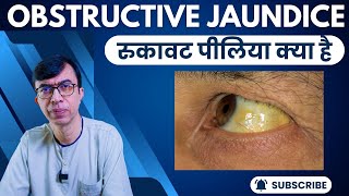 Obstructive Jaundice  रुकावट पीलिया क्या है और कैसे है इसका इलाज सामान्य पिलाया से अलग [upl. by Leagiba921]