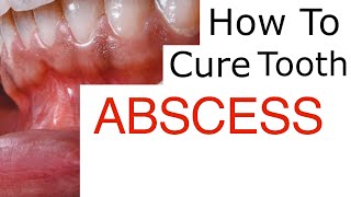 Tooth Abscess Explained [upl. by Hosfmann]