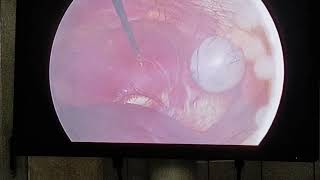 Laparoscopic Cholecystectomy [upl. by Schulman]