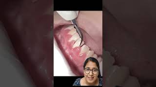 GINGIVAL INFLAMMATION  GINGIVITIS  shortsfeed youtubeshorts dentalclinic AS dental care viral [upl. by Thurston]