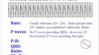 ECG Ventricular Tachycardia VT [upl. by Margalit]