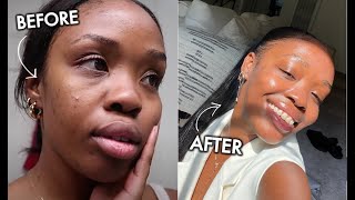 HOW I CLEARED MY ACNE  HYPERPIGMENTATION The BEST Skincare Products to Get Rid of Breakouts [upl. by Abih]