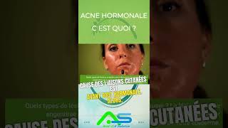 acne hormonale c est quoi [upl. by Huberty160]