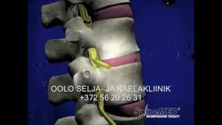 SPINAL DISC DECOMPRESSION THERAPY IN ESTONIA RUSSIA FINLAND AND CANADA ALTERNATIVE TO SURGERY [upl. by Rizika]