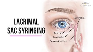 Lacrimal Syringing of the eye  Eye Solutions  The Complete Eye Hospital [upl. by Otsirave]