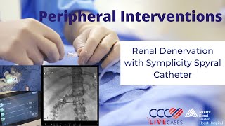 Renal Denervation with Symplicity Spyral Catheter  August 14th 2024 [upl. by Linker]