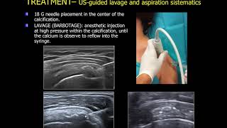 echoguided lavage of the calcific tendinitis of the shoulder [upl. by Uos]