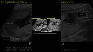 Posterior amp Fundal Placental Position On Ultrasound  Pregnancy USG posteriorplacenta placenta [upl. by Evol]