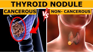 Cancerous vs Non cancerous Thyroid Nodules  How to Tell the Difference  Dr Gaurav Gangwani [upl. by Ocisnarf]