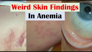 Anemia and Skin Findings along with Nail Changes and Mouth Sores [upl. by Ozmo780]