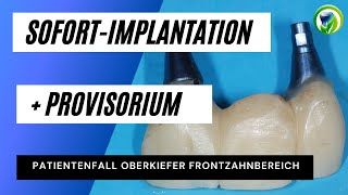 Sofortimplantation in der Oberkiefer Front mit festem Provisorium  Patientenfall vorher  nachher [upl. by Elfrieda]