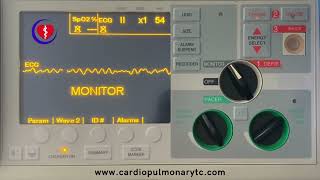 Fibrilación Ventricular  PALS [upl. by Noswal]