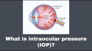 What is intraocular pressure IOP [upl. by Andryc]