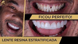 FECHAMENTO DE DIASTEMA EM UMA ÚNICA SESSÃO [upl. by Aneeras]