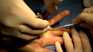 Trigger Finger Release with Cyst Excision [upl. by Ainslee462]