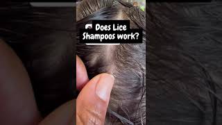 Does lice shampoos work l day in the life of a lice tech l lice removal service [upl. by Adleme]