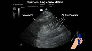 Lung consolidation [upl. by Grimes488]