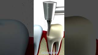 Dental Scaling amp Root Planing  prosper dentalscaling dentist deepcleaning [upl. by Anaitsirhc]