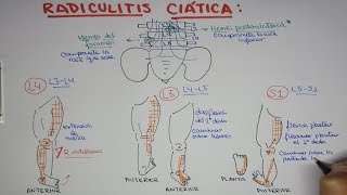 Radiculitis Ciática L4 L5 S1  Hernia de disco lumbar [upl. by Arielle]