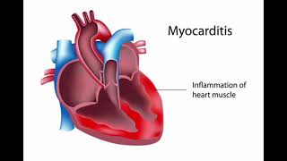 Myocarditis History Management mrcpch Clinical [upl. by Foulk656]