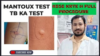 mantoux test full description mantoux test result in hindi [upl. by Brogle]