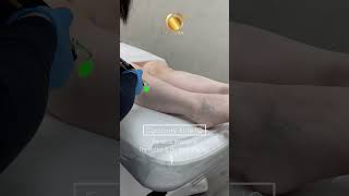 Cynosure Elite IQ laser hair removal [upl. by Rudman]